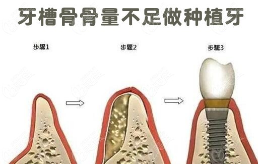 牙槽骨骨量不足做种植牙