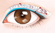杭州维多利亚做眼睛利用了血管保留术
