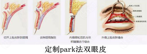 改良Park法切开