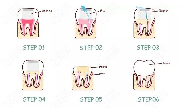 根管治疗后牙齿能用多久 这样做还能再维持几年