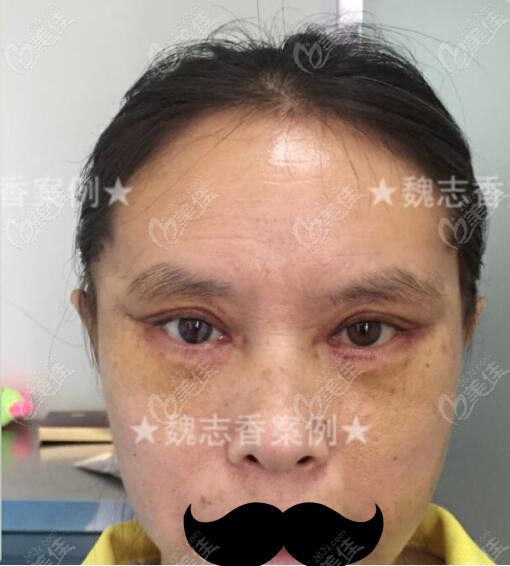 北京魏志香医生做的外切眼袋修复术7天效果反馈,她修复眼袋技术就是这么好