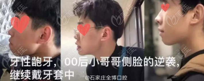 全博口腔顧客矯正前后對比圖