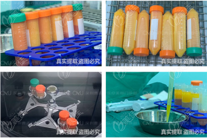 深圳曹孟君脂肪分离过程