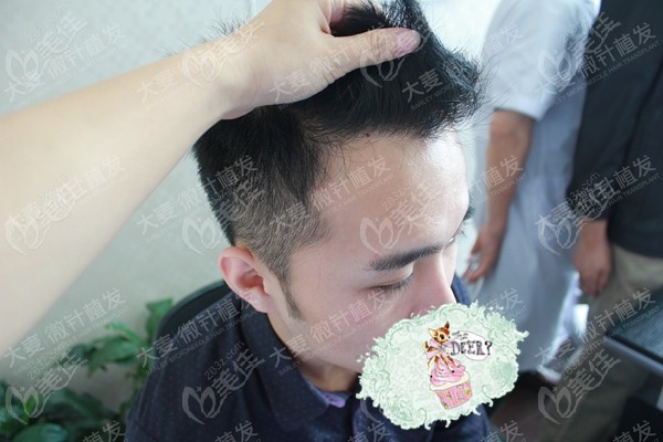 22岁男士前额发际线两个额角后退脱发,现已在郑州大麦微针植发成功逆袭!