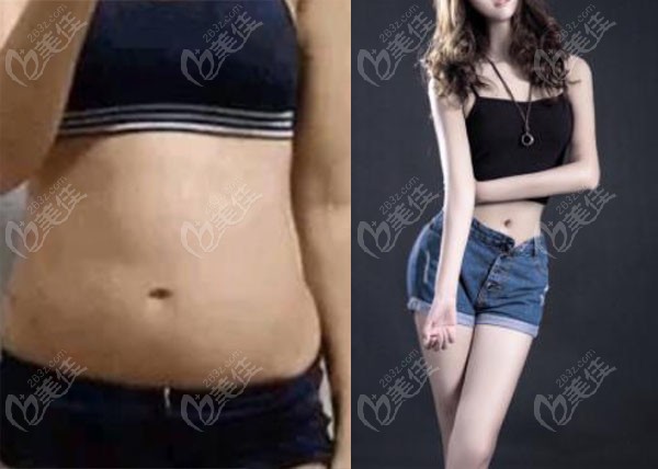 合肥韓美劉冷腰腹吸脂效果圖