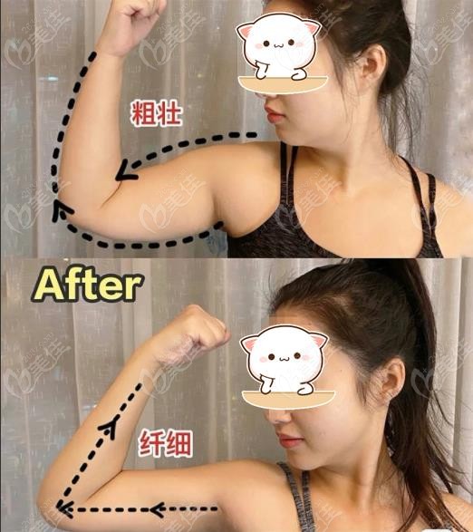 合肥韓美張曉龍手臂抽脂+面部吸脂效果圖
