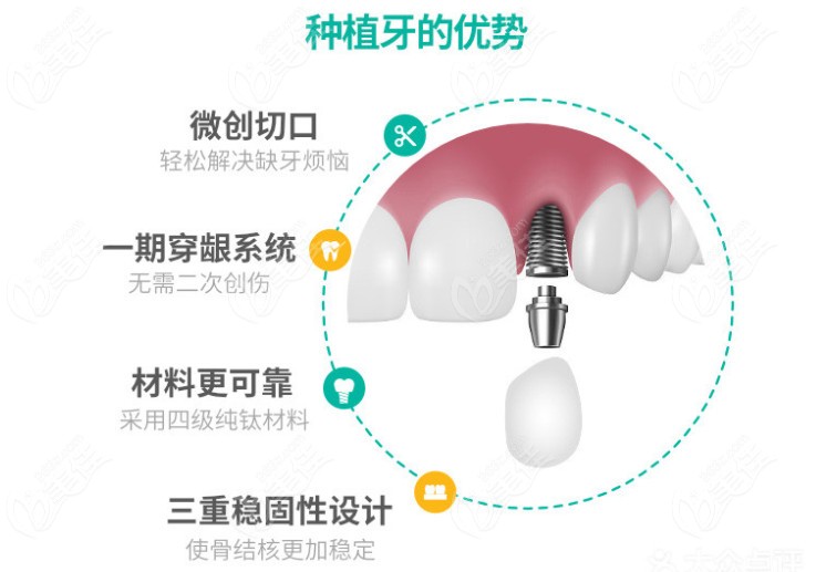 石家莊全博口腔種植牙的優(yōu)勢