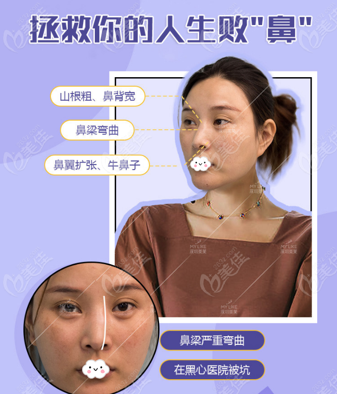 深圳鼻修复厉害的医生排名