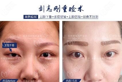 大连刘志刚重睑修复术真人对比照