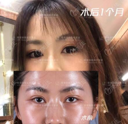 刘志刚埋线双眼皮失败修复术真人对比照