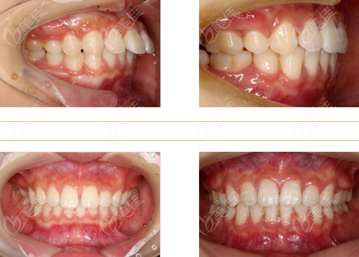 长沙雅美口腔的牙齿矫正前后对比图