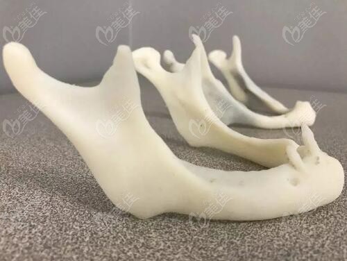 3d打印下頜骨技術(shù)怎么樣