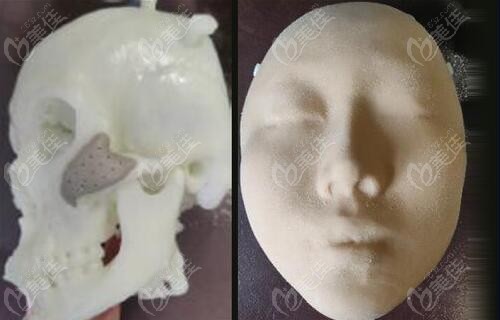 3d打印下頜骨技術(shù)介紹