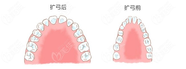 扩弓后口腔内牙齿前后对比