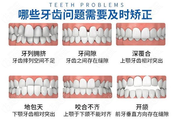8种牙齿情况需要及时矫正