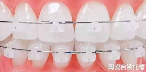 陶瓷半隐形固定牙套