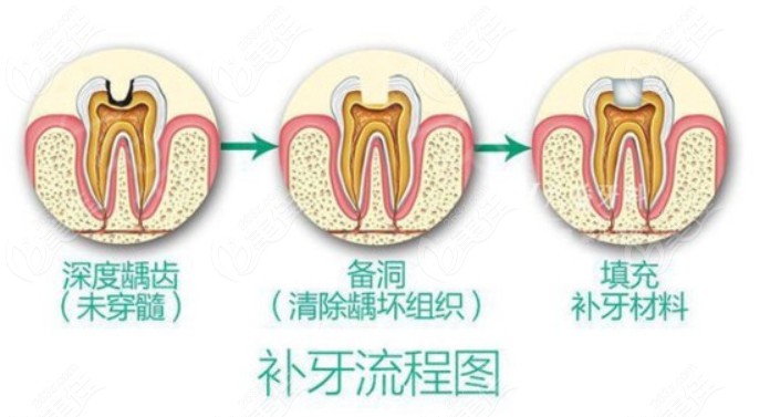 补牙的过程步骤