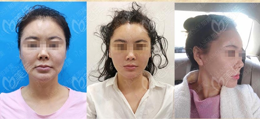 北京黄寅守医生做的小切口拉皮前后图