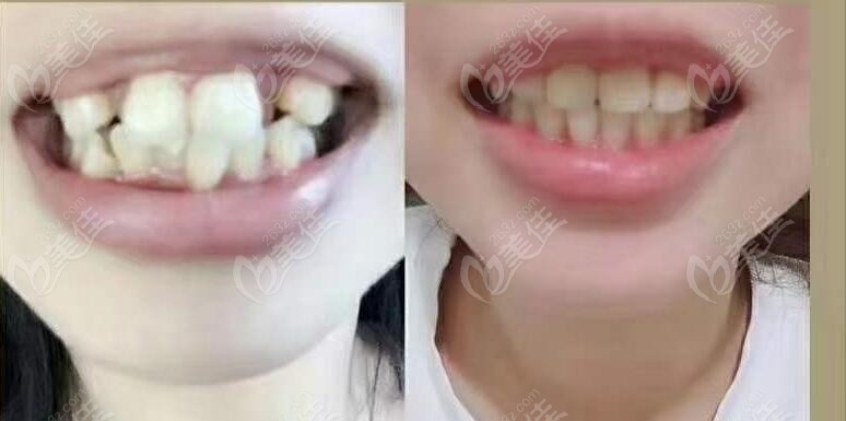中大口腔牙齿矫正病例