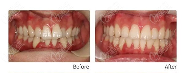 我用20个月的时间戴MBT直弓丝陶瓷托槽矫正器改善了牙齿拥挤不齐的问题
