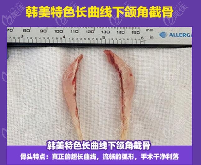 合肥韓美長曲線下頜角截下的骨頭照片