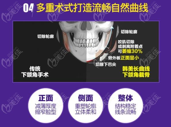 安徽韓美磨骨手術正面、側(cè)面改善都比較明顯