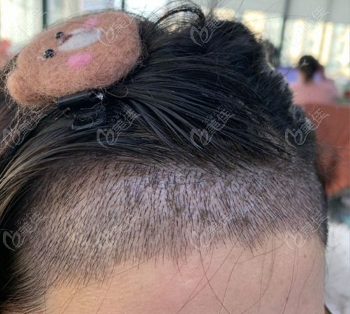 请欣赏绒毛发际线种植前后对比图,此效果图来源于青岛兴尚植发！