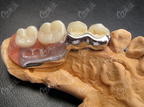 听说现在有个不伤邻牙的镶牙新方法是什么呀收费价格贵不贵