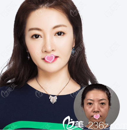北京上上相郑楚蓉做的ART鼻型改造和下巴延长增翘、丰面颊效果
