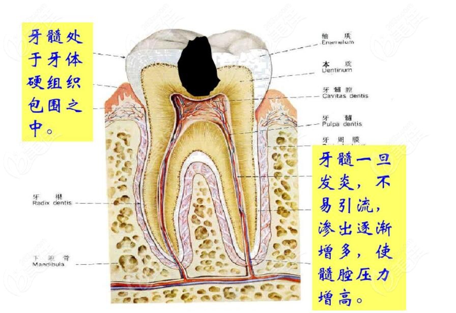 牙体牙髓病原因