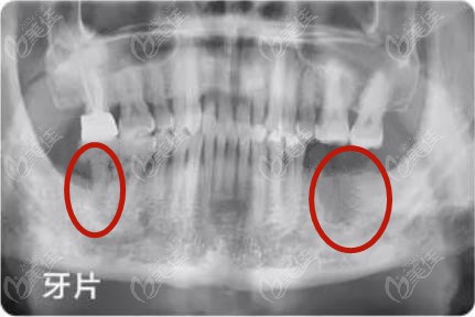 银川艾齿口腔种牙前的牙片显示