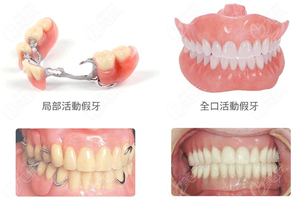 拔牙後多久可以鑲牙種植牙活動假牙臨時牙等鑲牙時間大有差異