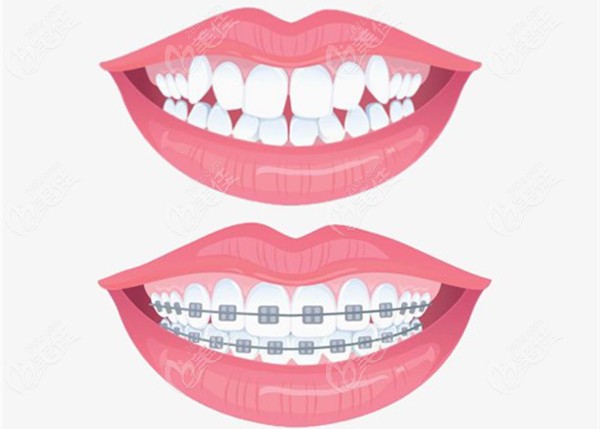牙齿矫正的前后效果对比