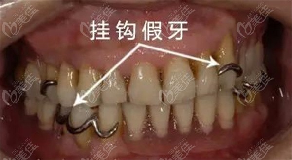 浅析无挂钩镶牙优缺点:不用摘除牙根也能戴上的一类假牙
