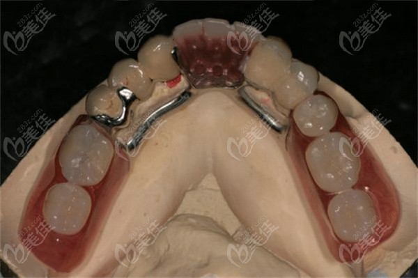 浅析无挂钩镶牙优缺点:不用摘除牙根也能戴上的一类假牙