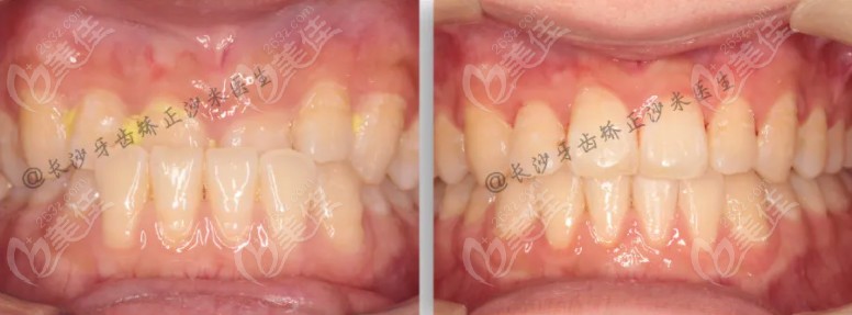 隐适美矫正前后对比图片