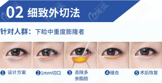 新疆整形医院祛眼袋蛮好的，而且7月外切去眼袋价格很划算！