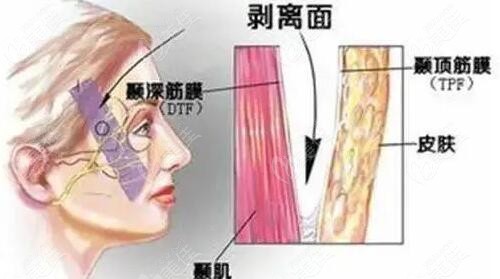 水剥离拉皮能维持几年