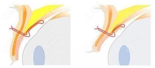修复双眼皮的技术原理