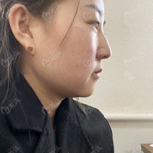 凹陷疤痕修复效果前后对比