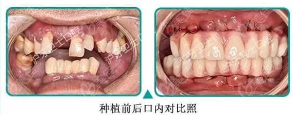 才知道他有家族性的血糖高,所以才導致了多顆牙缺失情況,還有牙齒鬆動