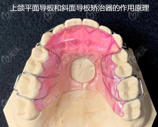 牙齿矫正平面导板图片图片