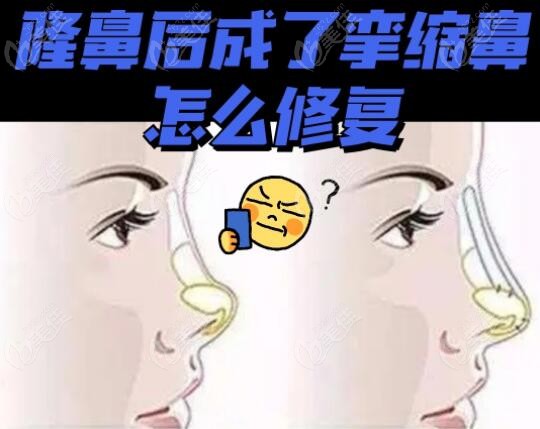 隆鼻后成了挛缩鼻修复