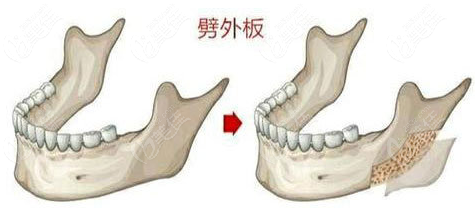 下颌角外板辟出效果图