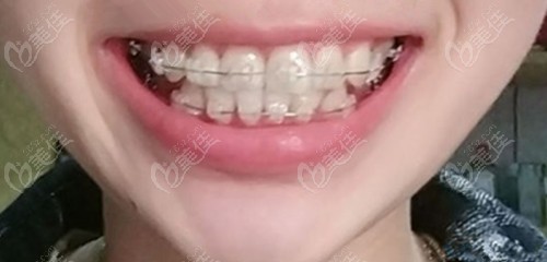 牙齿错颌畸形选陶瓷半隐形矫正两个月就能看到效果你敢信？