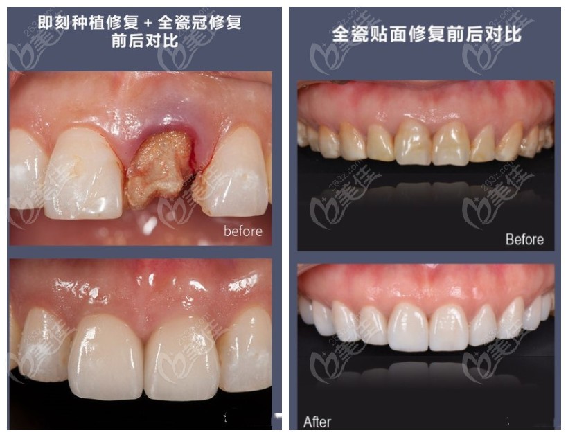 维乐口腔即刻种植牙和美学贴面病例