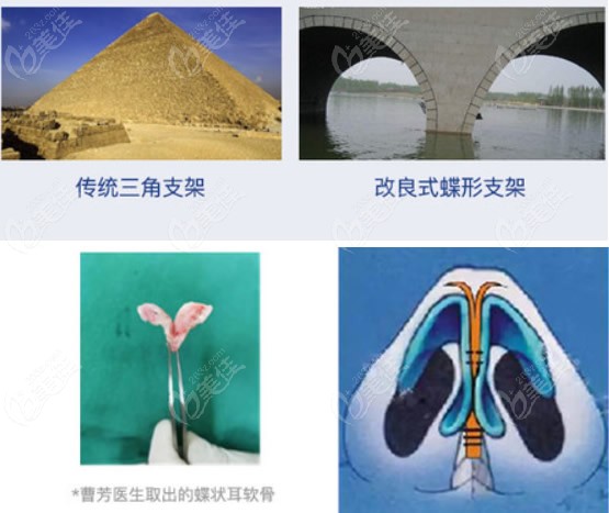 上海伯思立曹芳医生蝶拱鼻性形状