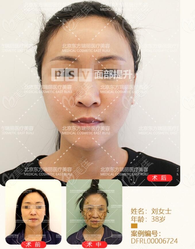 李晓东医生做的psv面部提升术前术后对比照片