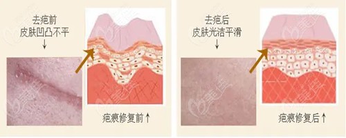 祛疤原理和效果