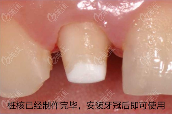 做桩核冠修复大概多少钱尤其是纤维桩加全瓷冠的价格